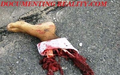 foot-torn-off3.jpg