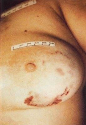 bite-marks.jpg