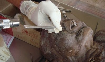 lateral-ostetomy.jpg