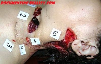 neck-wounds.jpg