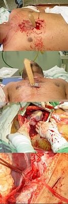 stabbed-chest.jpg