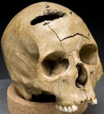 gunshot_skull_civil_war.jpg