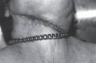 strangulation-hanging-chain-ligature-showing-patterned-abrasion..jpg