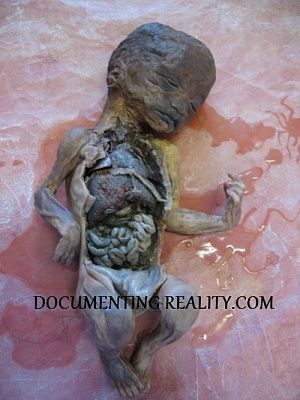 dead-child-autopsy.jpg