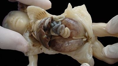 meckel-gruber-syndrome.jpg