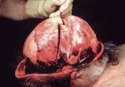 brain-removal.gif