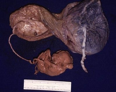 stillborn-placenta.jpg