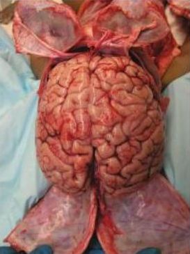 An-alternative-way-to-open-the-skull.jpg