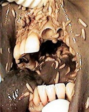 Maggot activity seen around the oral and nasal passages during autopsy. Note the appearance of p.jpg