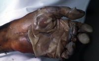 Name:  degloving.jpg
Views: 3273
Size:  14.5 KB