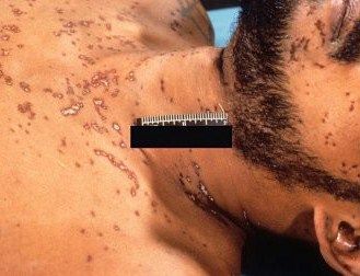 Name:  Postmortem%20fire%20ant%20bite%20marks%2C%20with%20no%20evidence%20of%20a%20vital%20tissue%20rea.jpg
Views: 10305
Size:  24.2 KB