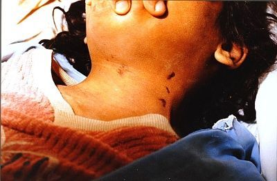 strangulation-20nail-20abrasions-201.jpg