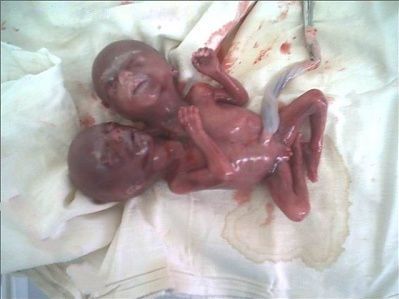conjoined twins %281%29.jpg