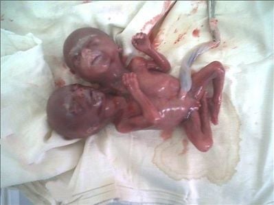 conjoined-twins-281-29.jpg