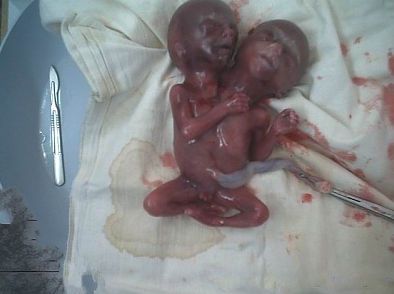 conjoined-twins-%282%29.jpg