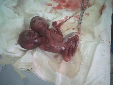 conjoined-twins-%283%29.jpg