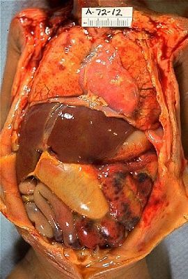 neonatal-20necrotizing-20enterocolitis.jpg