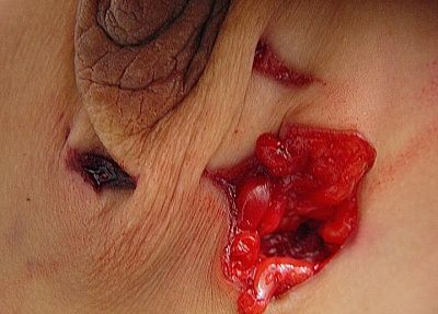 stab-20wound-204.jpg