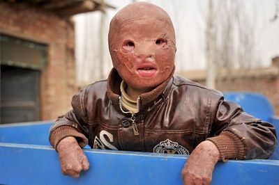 burnt-boy.jpg