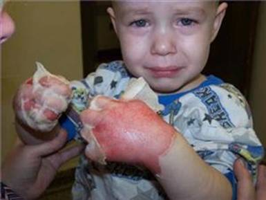 burnt hands.jpg