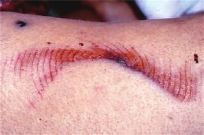 abrasions-20consisting-20of-20multiple-20superficial-20lineral-20pattern-20lines2.jpg