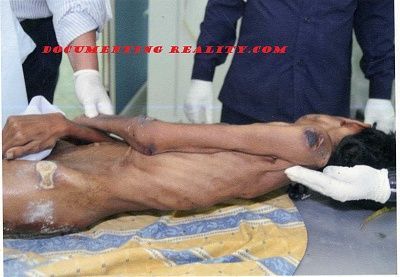 cancer-20patient-20-281-29.jpg
