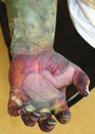 Mummification%20of%20the%20fingertips%20with%20an%20expanded%20gas%20filled%20blister%20and%20gr.jpg