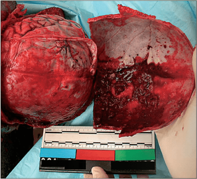 blood-20inside-20the-20cranium-20is-20a-20common-20finding-20in-20fire-20victims.-20the-20large-.png