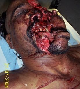 cranioSpinal3.jpg