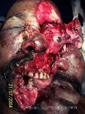 cranioSpinal4.jpg
