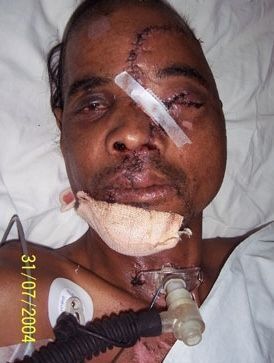 cranioSpinal2.jpg