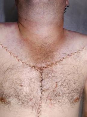 Name:  y%20incision%201.jpg
Views: 11437
Size:  17.1 KB