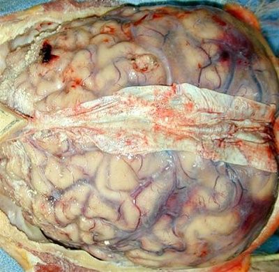 brain-20with-20cocci-20meningitis..jpg