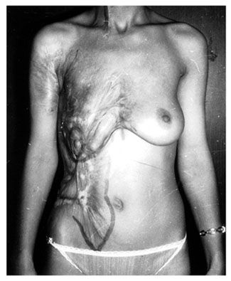 MeltingBoob-BurntWomen-Thread.jpg