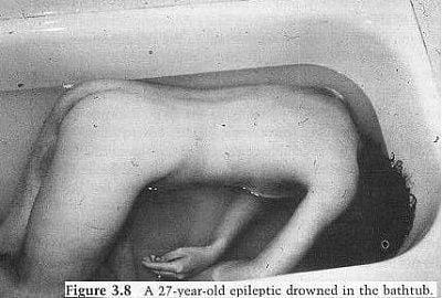 epileptic-drowned-bath.jpg