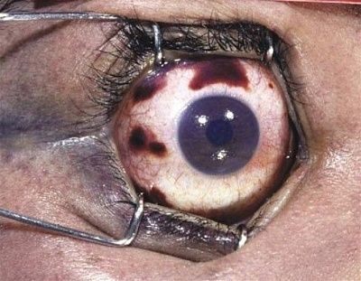 eye.jpg