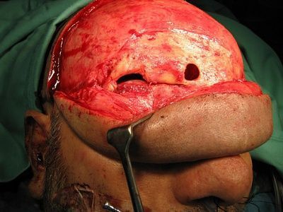 rightfrontalwound33.jpg