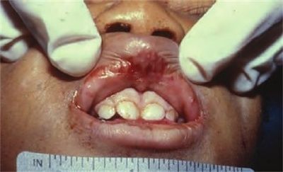 abrasions-20of-20the-20face-20with-20trauma-20to-20the-20lips-20and-20torn-20frenulaa.jpg
