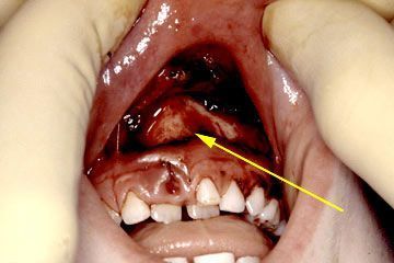 De-gloving%20injuries%20to%20mandibular%20gingival%20mucosa%20De-gloving%20injury%20to.JPG