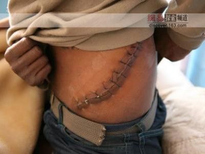 kidney-removal-scar[1].jpg