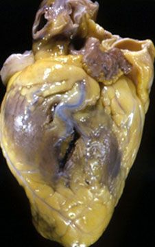 Name:  Photograph%20of%20the%20heart%20of%20a%2043-year-old%20man%20demonstrating%20the%20site%20of%20a.jpg
Views: 2100
Size:  29.2 KB