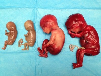 ivf.jpg