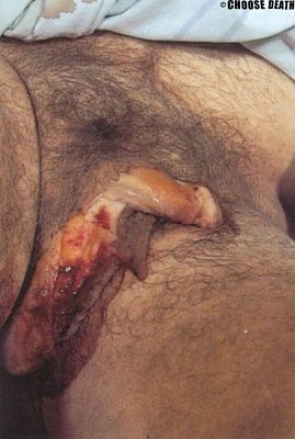 dogbite.jpg