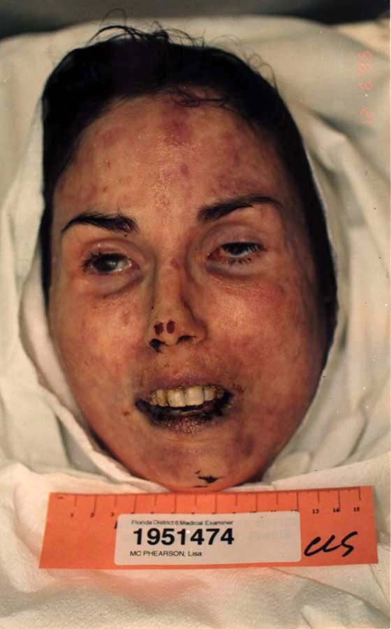 49117d1242003916-lisa-mcpherson-autopsy-pictures-full-set-face2.jpg