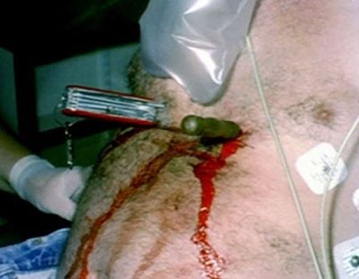 stab_wound_pictures_003.jpg