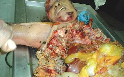 zeza87425stoveexplosionvictim2.jpg