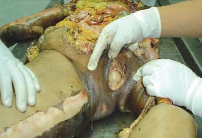 zeza87425stoveexplosionvictim3.jpg