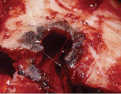 38_special_bullet_wounds_002.jpg