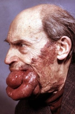 hemangioma.jpg