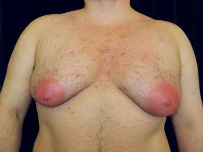 1%20a%20a%20Gynomastia%2001.JPG